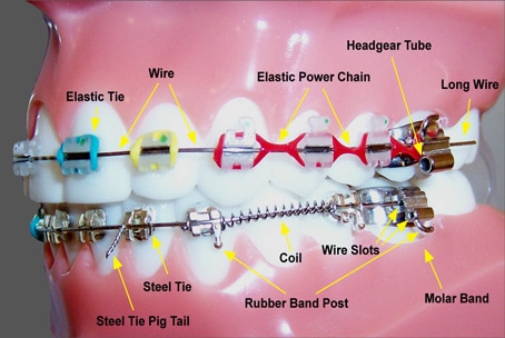 Orthodontic elastics springs coils and hooks