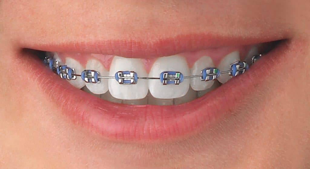 Board-Certified Orthodontist in San Carlos, CA, Invisalign, Braces