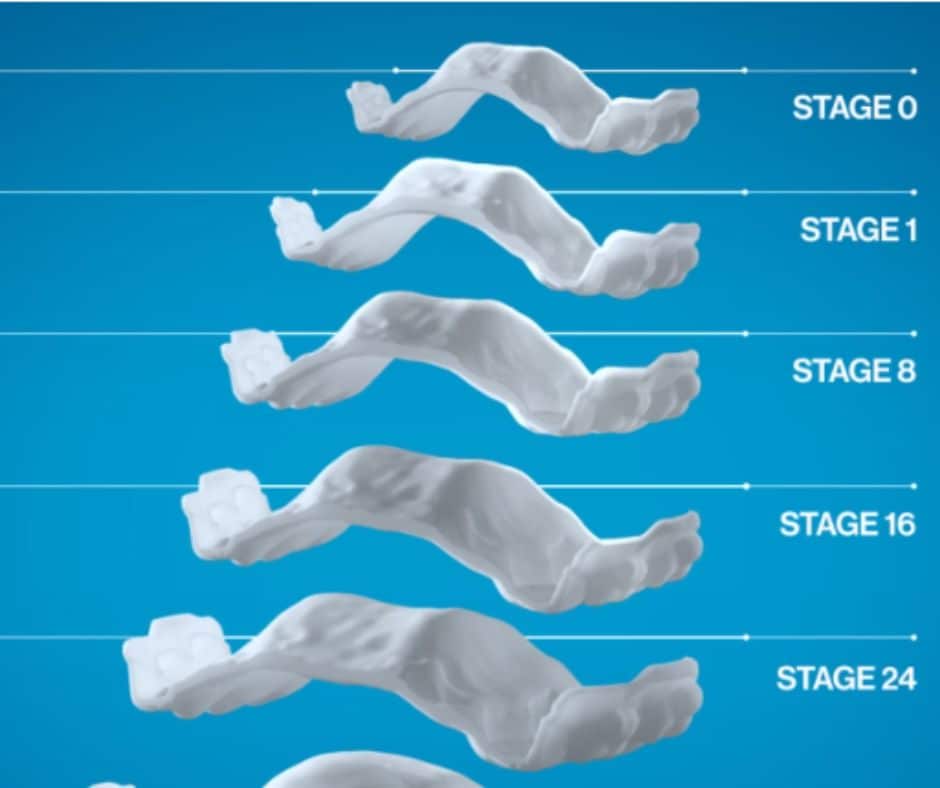 stages of invisalign expander
